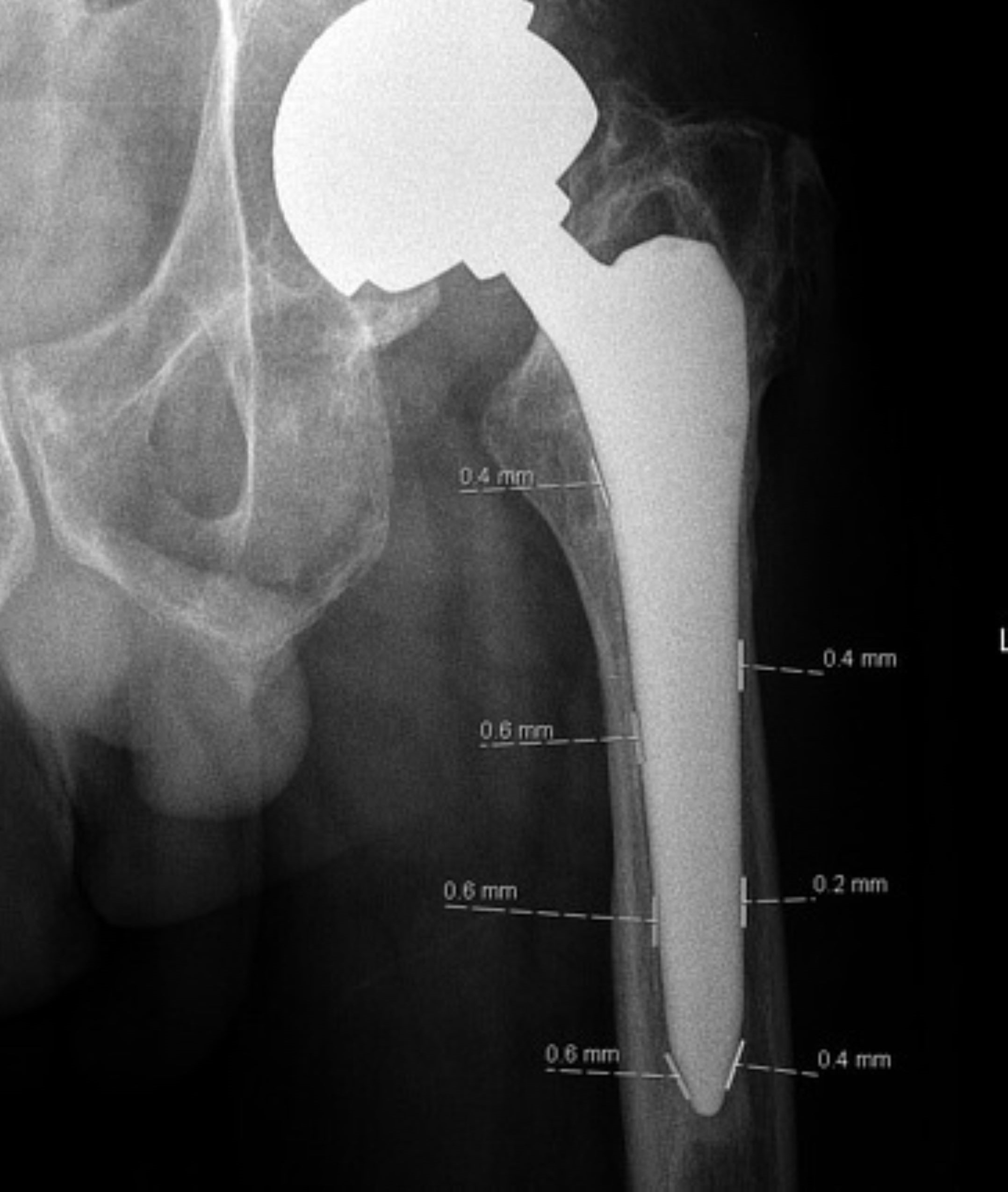 Image of Hip Implant